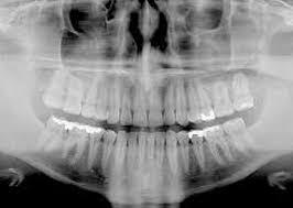 Diş Eti Hastalıkları: Periodontoloji