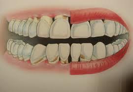 Diş Eti Hastalıkları: Periodontoloji