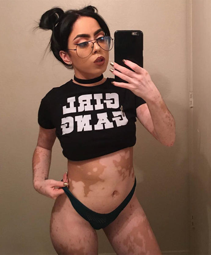 Vitiligo Olduğu İçin Ömrü Boyunca Zorbalık Gören Kız Vücudunu Sanat Eserine Dönüştürdü
