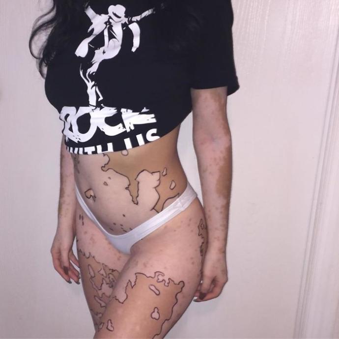 Vitiligo Olduğu İçin Ömrü Boyunca Zorbalık Gören Kız Vücudunu Sanat Eserine Dönüştürdü