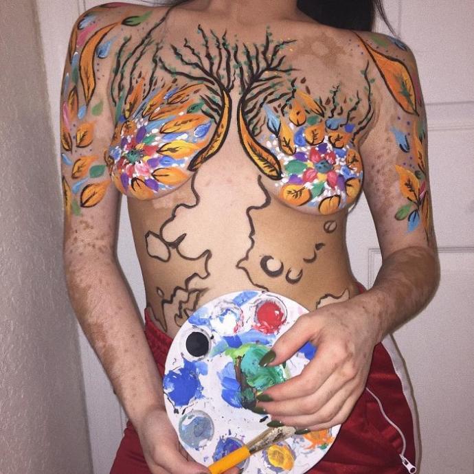 Vitiligo Olduğu İçin Ömrü Boyunca Zorbalık Gören Kız Vücudunu Sanat Eserine Dönüştürdü