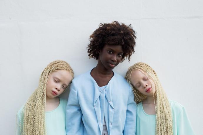 Onlar Bildiğiniz Gibi Değil, Onlar Çok Farklı: İkiz Albino Modeller!