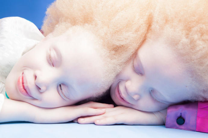 Onlar Bildiğiniz Gibi Değil, Onlar Çok Farklı: İkiz Albino Modeller!
