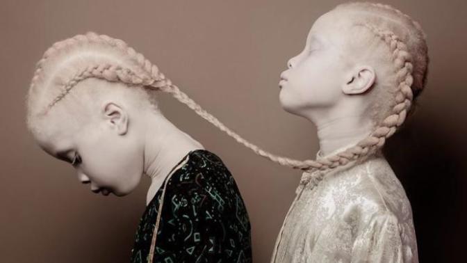 Onlar Bildiğiniz Gibi Değil, Onlar Çok Farklı: İkiz Albino Modeller!