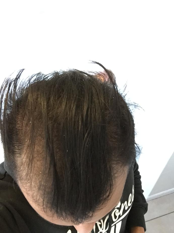 Saçları Dökülen Her Erkek Bir Kısım Muzdariptir! Dutasterid, Minoxidil, Ketokonazol Mucizesi...