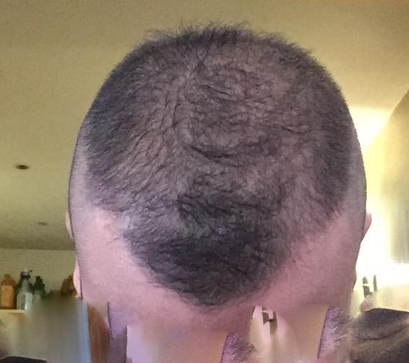 Saçları Dökülen Her Erkek Bir Kısım Muzdariptir! Dutasterid, Minoxidil, Ketokonazol Mucizesi...