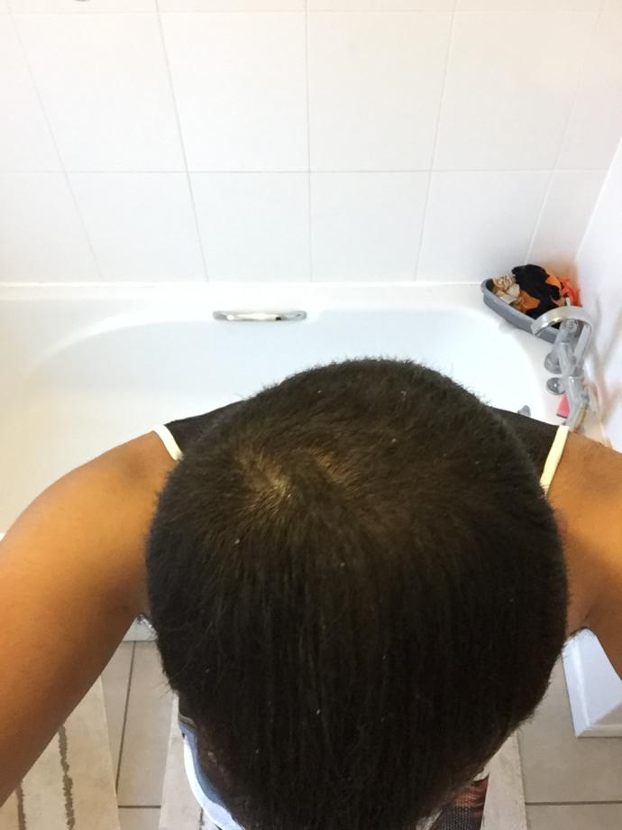 Saçları Dökülen Her Erkek Bir Kısım Muzdariptir! Dutasterid, Minoxidil, Ketokonazol Mucizesi...