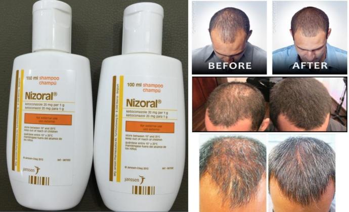 Saçları Dökülen Her Erkek Bir Kısım Muzdariptir! Dutasterid, Minoxidil, Ketokonazol Mucizesi...