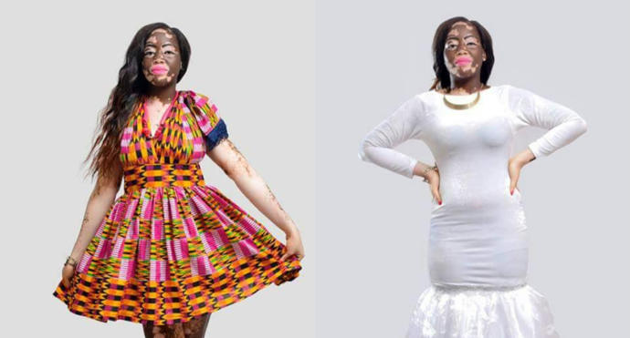 Bir Zamanlar Fakir Ama Gururlu Bir Genç Vardı: Yıllarca Küçümsenen Vitiligo Kadın Şimdi Model!