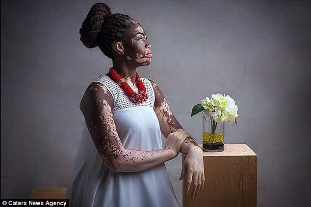 Bir Zamanların Fakir Ama Gururlu Genci Vitiligo Kadın Şimdi Model!