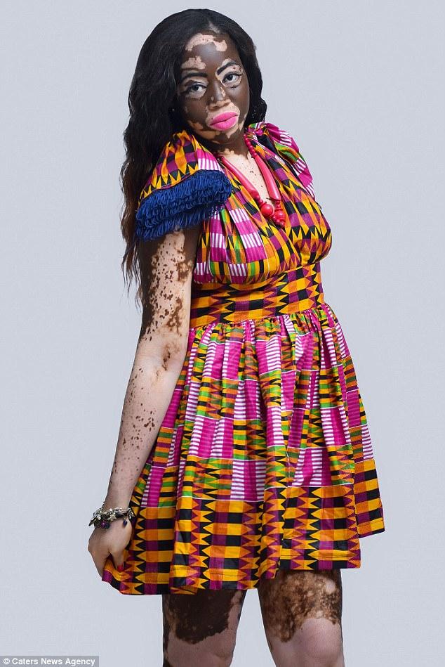 Bir Zamanların Fakir Ama Gururlu Genci Vitiligo Kadın Şimdi Model!