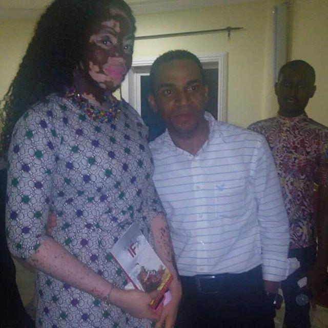 Bir Zamanların Fakir Ama Gururlu Genci Vitiligo Kadın Şimdi Model!