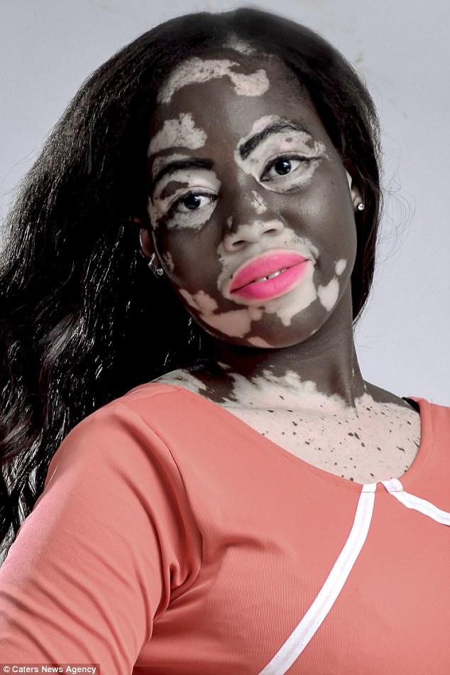 Bir Zamanların Fakir Ama Gururlu Genci Vitiligo Kadın Şimdi Model!