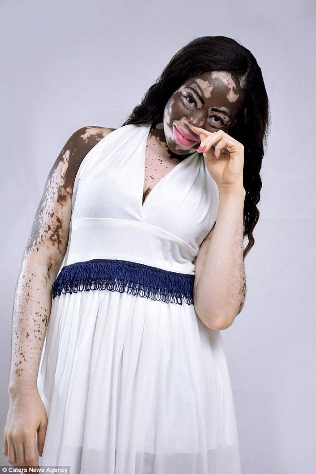 Bir Zamanların Fakir Ama Gururlu Genci Vitiligo Kadın Şimdi Model!