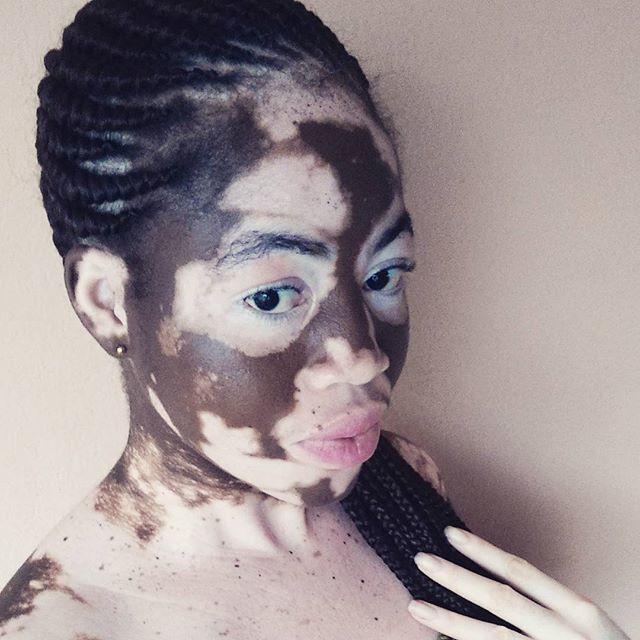Bir Zamanların Fakir Ama Gururlu Genci Vitiligo Kadın Şimdi Model!