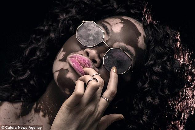 Bir Zamanların Fakir Ama Gururlu Genci Vitiligo Kadın Şimdi Model!