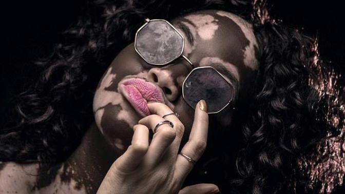 Bir Zamanların Fakir Ama Gururlu Genci Vitiligo Kadın Şimdi Model!