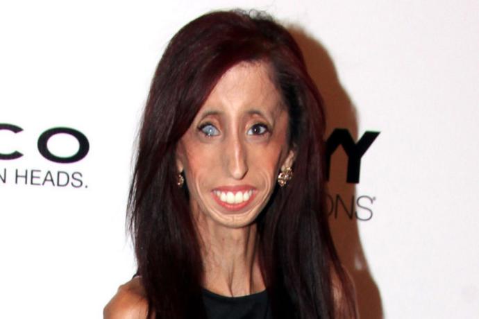 Öz Güveni ve Cesaretiyle Herkese Örnek Olan Kadın: Lizzie Velasquez