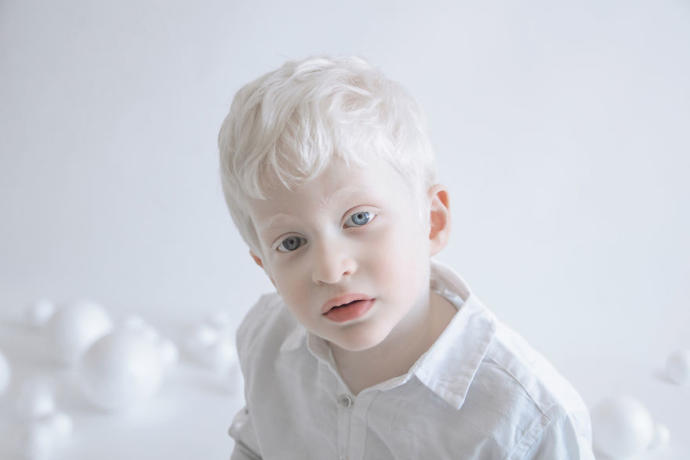 Farklılıkların Eşsiz Olduğunu İspat Eden Albino Modeller