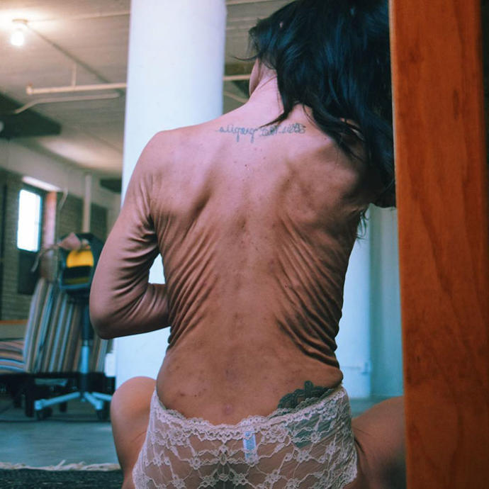 Henüz 26 Yaşında Olmasına Rağmen EDS Sendromu Nedeniyle Yaşından Büyük Gösteren Model: Sara Geurts!
