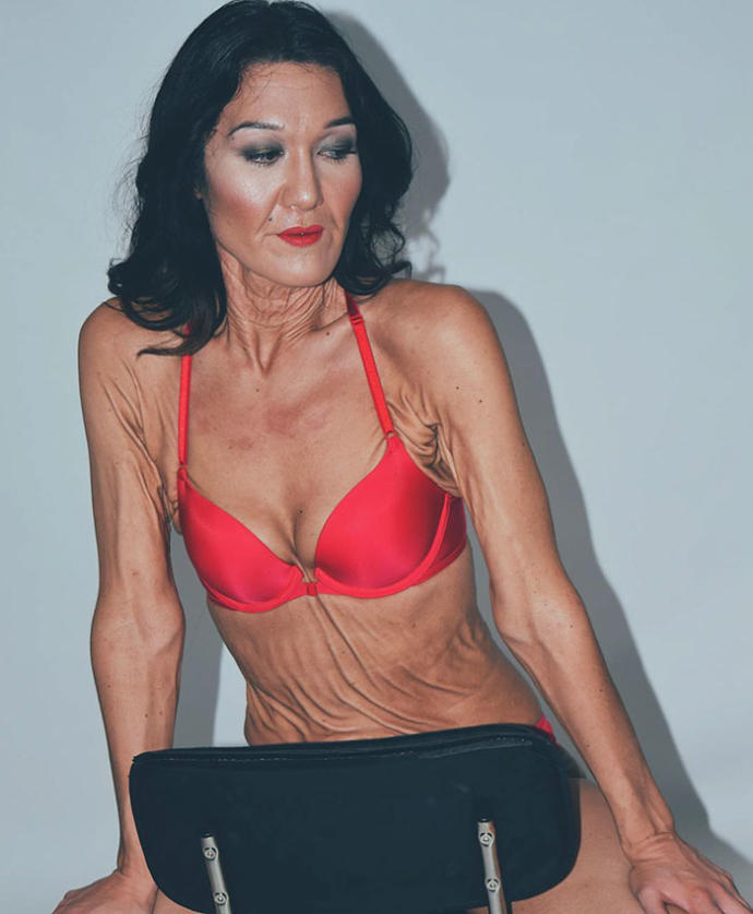 Henüz 26 Yaşında Olmasına Rağmen EDS Sendromu Nedeniyle Yaşından Büyük Gösteren Model: Sara Geurts!