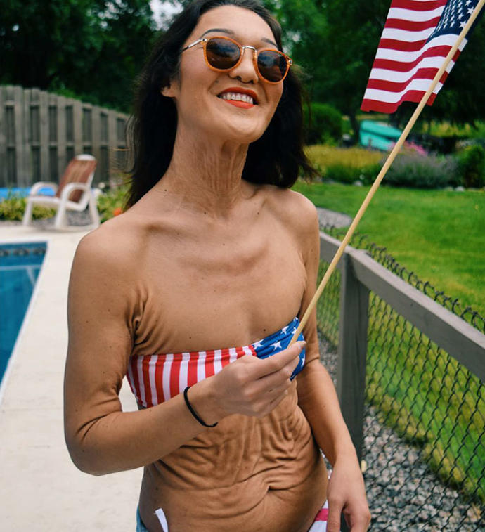 Henüz 26 Yaşında Olmasına Rağmen EDS Sendromu Nedeniyle Yaşından Büyük Gösteren Model: Sara Geurts!