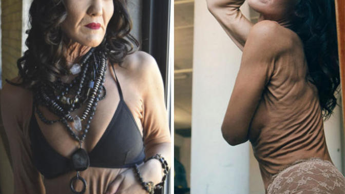Henüz 26 Yaşında Olmasına Rağmen EDS Sendromu Nedeniyle Yaşından Büyük Gösteren Model: Sara Geurts!