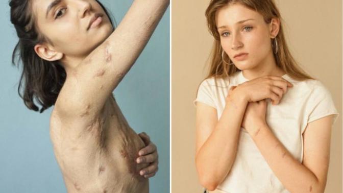 Vücudundaki Yara İzlerini Sergilemekten Çekinmeyen 10 Cesur Yürek
