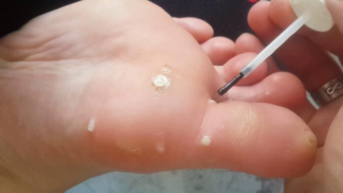 Tavuk Gözü Siğili Nasıl Geçer, Yok Edilir?