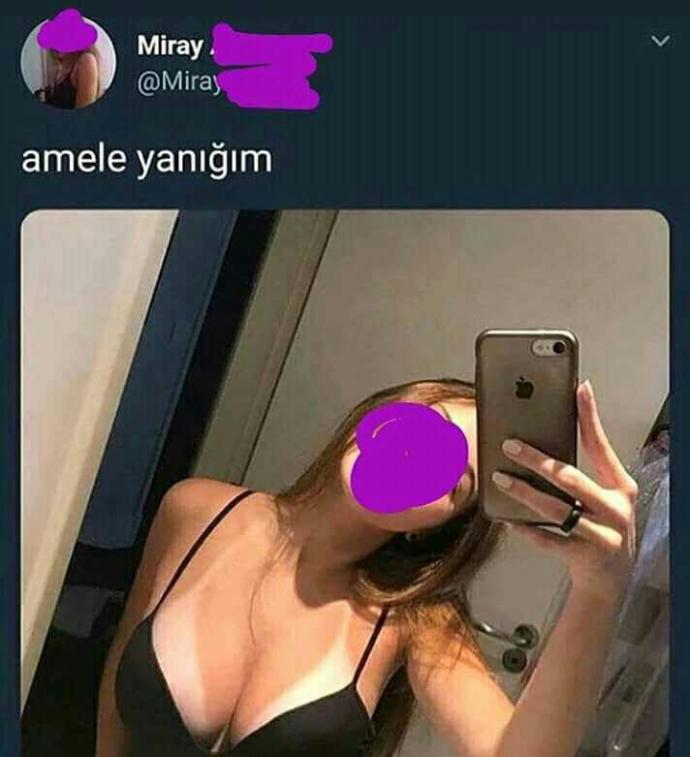 Kızlar sizde de amele yanığı var mı?