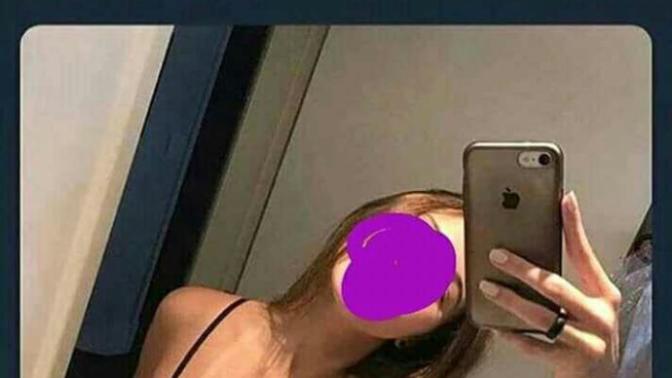 Kızlar sizde de amele yanığı var mı?