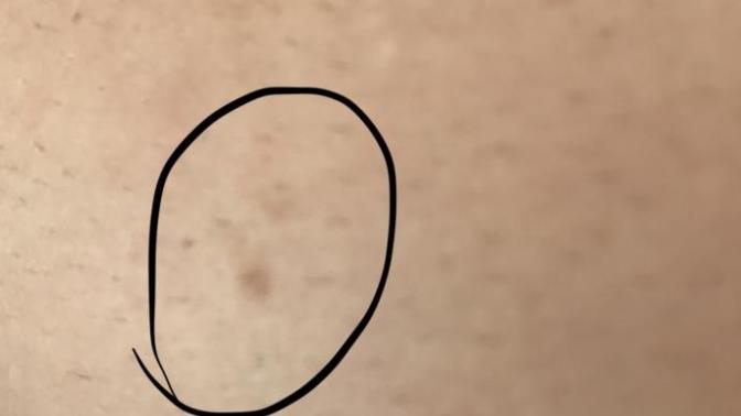 Lazer epilasyona gidiyorum vucudumda leke yokken lazer sonrası bunlar oluştu güneş lekesimi lazerdenmi bilmiyorum nasıl geçer?