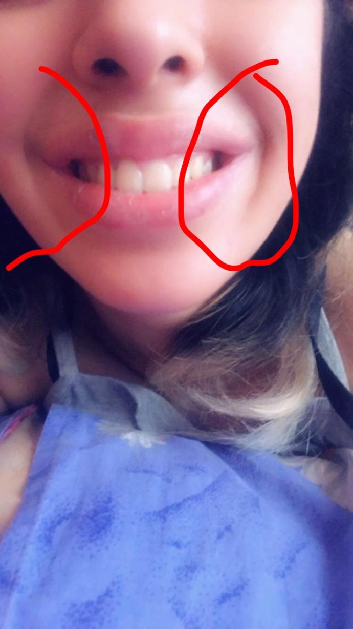 Gülünce yanağımın yanı böyle oluyor?