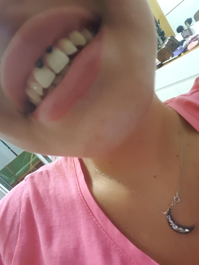 Smiley piercing yaptırdım ama simetrik bir şekilde dişimin üzerine düşmüyor?