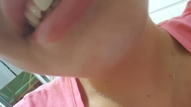 Smiley piercing yaptırdım ama simetrik bir şekilde dişimin üzerine düşmüyor?