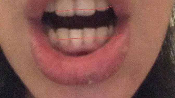 Braces Before And After Breket Sokumu Keramik Breket Dis Telleri Sokumu Dis Tellerimden Kurtuldum Youtube