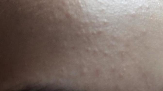 Yüzüm pürüzsüz ancak alnım fotoğraf da olduğu gibi. Ne yapsam geçer?
