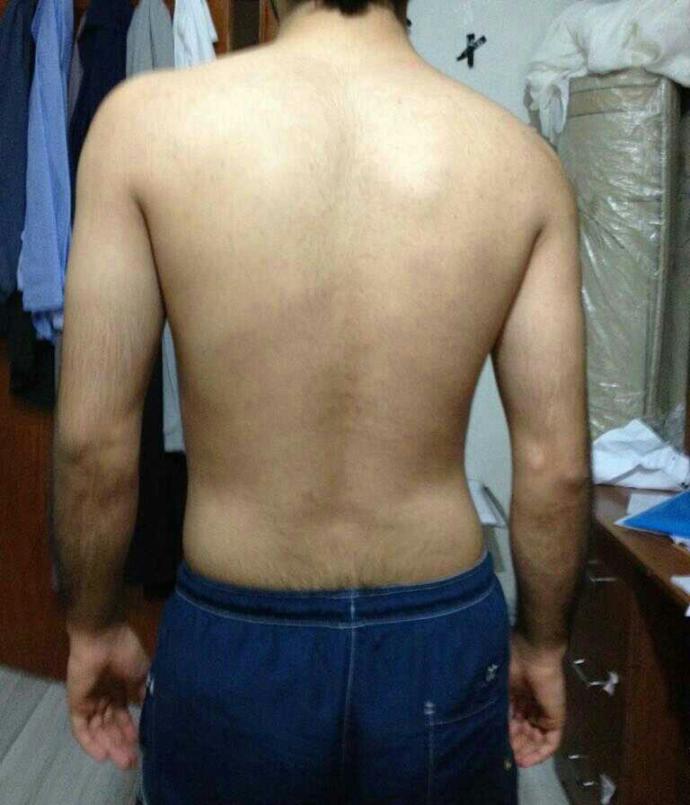 Vücudumdaki postür bozukluğunu ne yapicam?