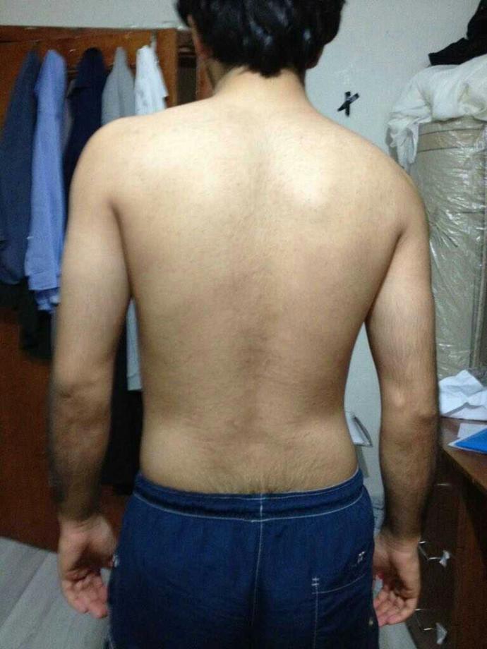 Vücudumdaki postür bozukluğunu ne yapicam?