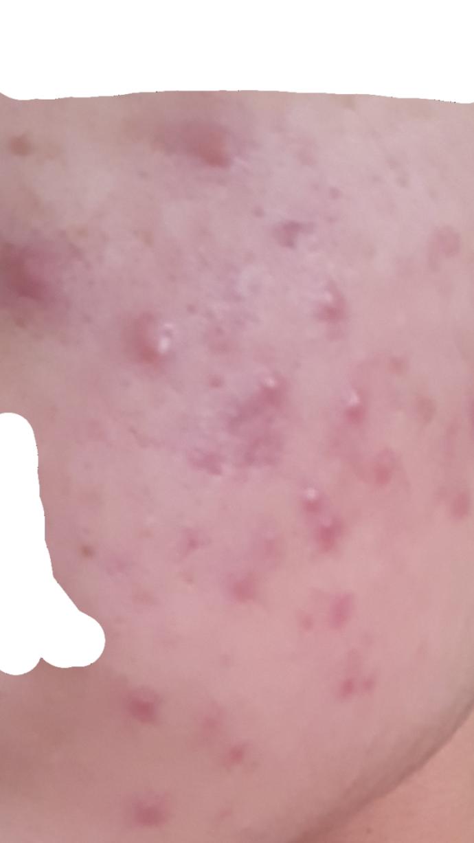 Roaccutane Kullananlar? Roaccutane Meme kanseri yapar mı? Kısırlık yapar mi? Yumurtalıklarda kist oluşumunu tetikler mi?