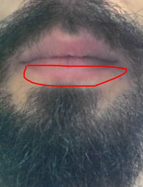 Dudakta kızarıklık?