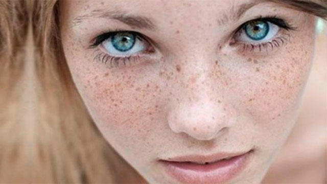 Çiller Nasıl Yok Edilir? Çillerden Kurtulmak için Maske Önerileri?