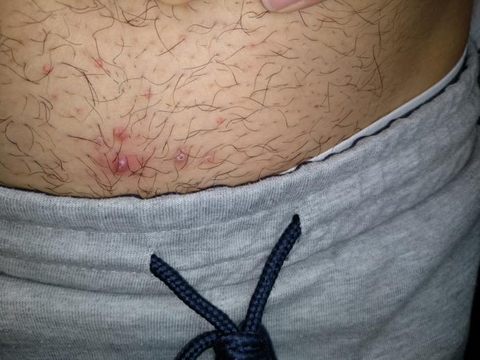 Bu sivilceler bir türlü azalmıyor ne önerirsiniz?