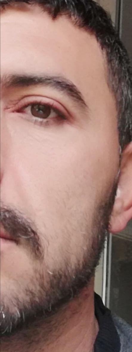 Göz kapağında ki şişlik?
