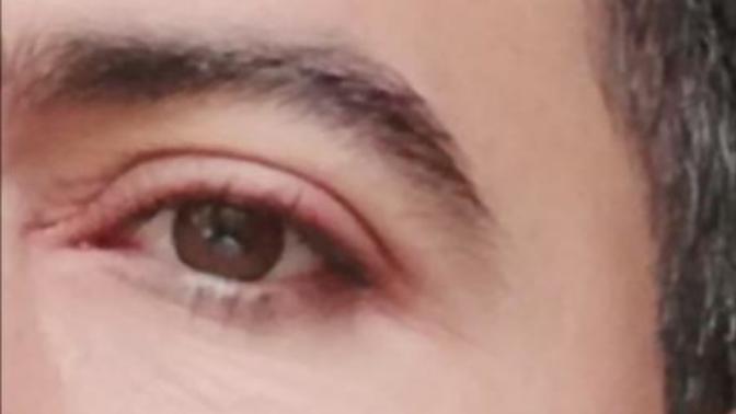 Göz kapağında ki şişlik?