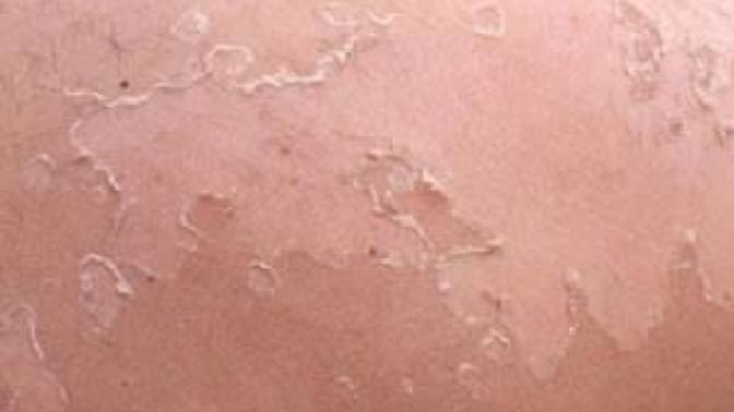 Derim soyuluyor iğrenç bir şekilde deri döküntülerim var. Nasıl tüm deriyi soyabilirim ya da peeling ile gider mi bu soyuklar?