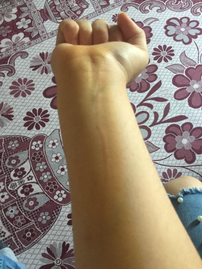 Kedi kolumu tırmaladı kuduz olurmuyum veya aşı olmalımıyım?