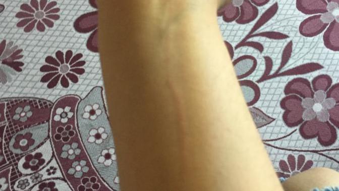 Kedi kolumu tırmaladı kuduz olurmuyum veya aşı olmalımıyım?