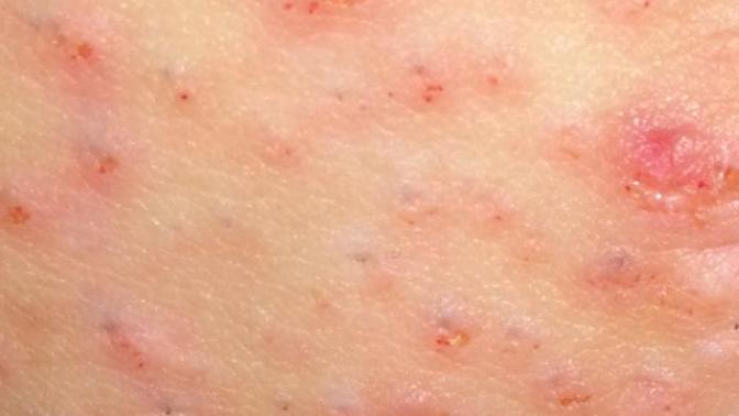 Her ağda ya da jilet sonrasında genital bölgedeki sivilcelenme tahriş için ne yapabilirim canım acıyor şu an?