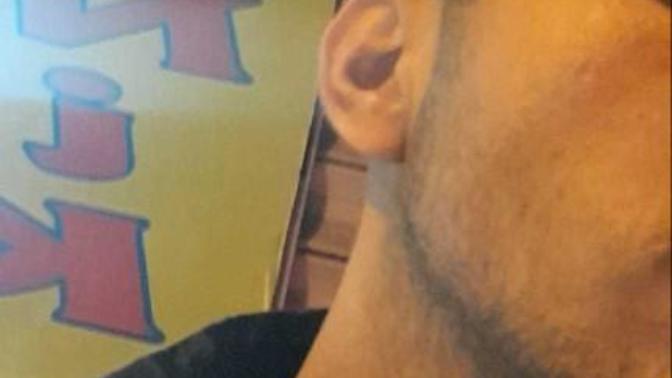 Yüzüm de ki su çiçeği nasıl geçer?